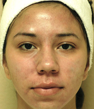 Patient 2 after photo of Acne & Acne Scar Laser Treatment patient at Sensational Skin Scottsdale