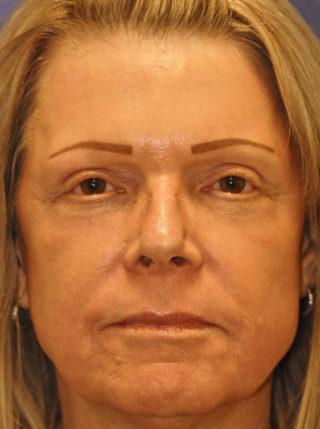 Patient 4 after photo of MaxFX CO2 Laser Resurfacing patient at Sensational Skin Scottsdale