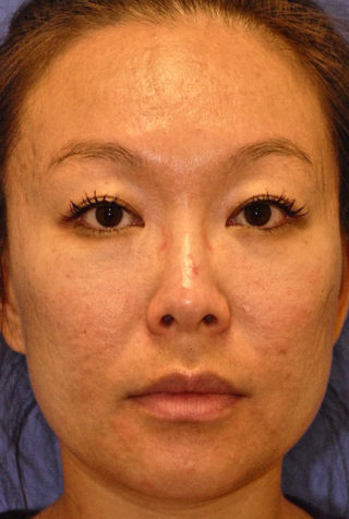 Before MaxFX CO2 Laser Resurfacing patient