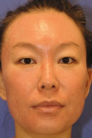 After MaxFX CO2 Laser Resurfacing patient