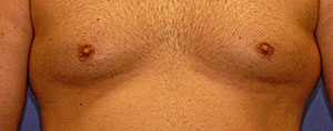 Before Body Procedures patient