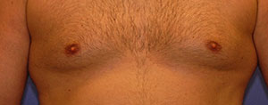 After Body Procedures patient
