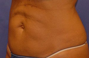 Before Body Procedures patient