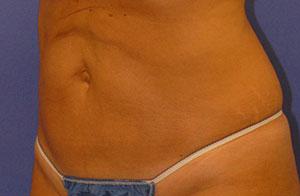 After Body Procedures patient