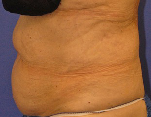 Patient 3 before photo of Coolsculpting patient at Sensational Skin Scottsdale
