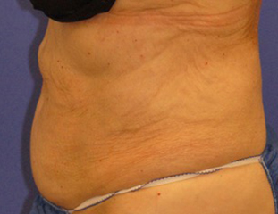 Patient 3 after photo of Coolsculpting patient at Sensational Skin Scottsdale