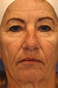 Patient 5 before photo of PDO Threadlift patient at Sensational Skin Scottsdale