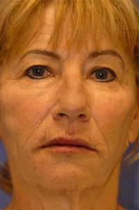 Patient 5 after photo of PDO Threadlift patient at Sensational Skin Scottsdale