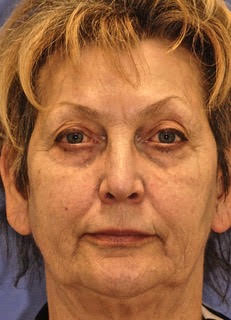 Patient 5 before photo of MaxFX CO2 Laser Resurfacing patient at Sensational Skin Scottsdale