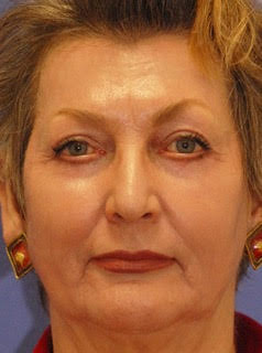 Patient 5 after photo of MaxFX CO2 Laser Resurfacing patient at Sensational Skin Scottsdale