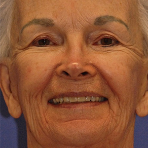 Patient 17 before photo of Face Procedures patient at Sensational Skin Scottsdale
