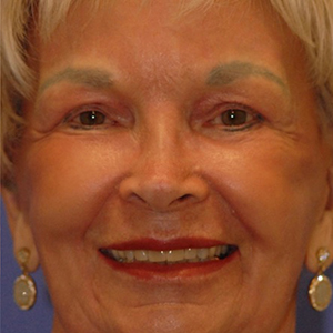 Patient 17 after photo of Face Procedures patient at Sensational Skin Scottsdale