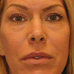 Patient 18 after photo of Face Procedures patient at Sensational Skin Scottsdale