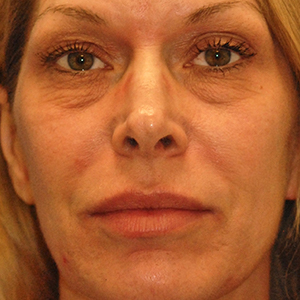Patient 18 before photo of Face Procedures patient at Sensational Skin Scottsdale