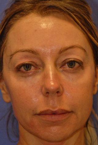 Patient 7 before photo of PDO Threadlift patient at Sensational Skin Scottsdale