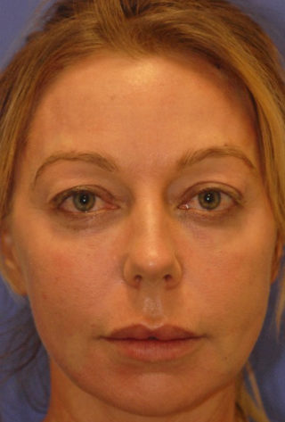 Patient 7 after photo of PDO Threadlift patient at Sensational Skin Scottsdale