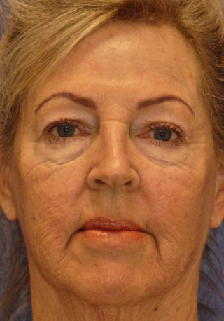 Patient 2 before photo of Profound Lift patient at Sensational Skin Scottsdale