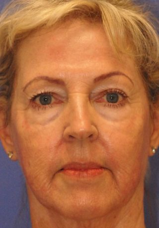 Patient 2 after photo of Profound Lift patient at Sensational Skin Scottsdale