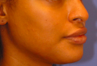 Patient 8 before photo of PDO Threadlift patient at Sensational Skin Scottsdale