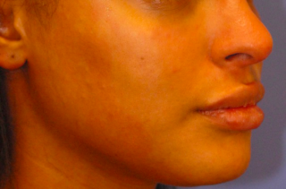 Patient 8 after photo of PDO Threadlift patient at Sensational Skin Scottsdale