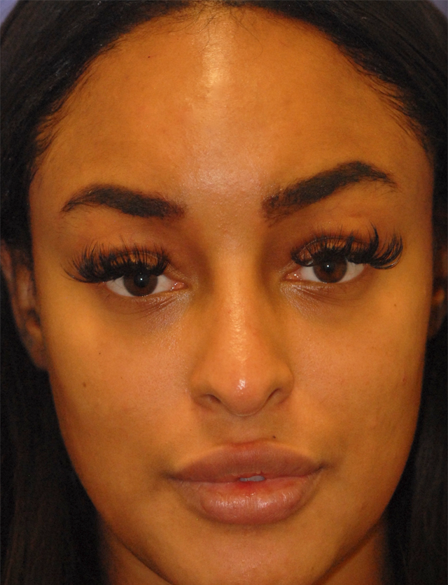 Patient 8 before photo of PDO Threadlift patient at Sensational Skin Scottsdale