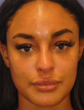 Patient 8 after photo of PDO Threadlift patient at Sensational Skin Scottsdale
