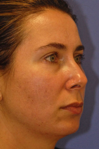 Patient 1 before photo of Radiesse patient at Sensational Skin Scottsdale
