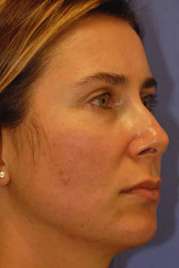 Patient 1 after photo of Radiesse patient at Sensational Skin Scottsdale