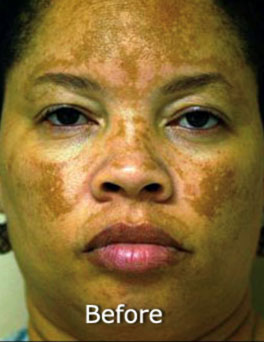 Patient 52 before photo of ZO Skin Health patient at Sensational Skin Scottsdale