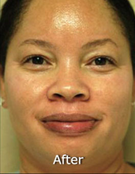Patient 52 after photo of ZO Skin Health patient at Sensational Skin Scottsdale