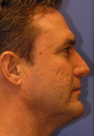 Patient 2 before photo of Acne Scars patient at Sensational Skin Scottsdale