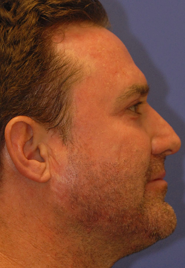 Patient 2 after photo of Acne Scars patient at Sensational Skin Scottsdale