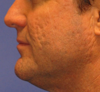 Patient 2 before photo of Acne Scars patient at Sensational Skin Scottsdale