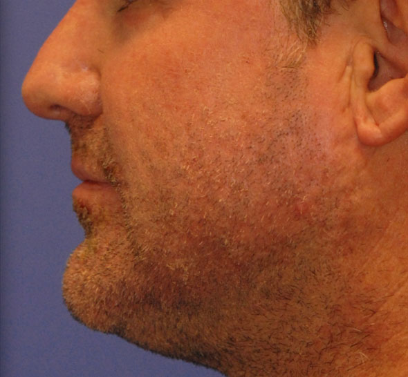 Patient 2 after photo of Acne Scars patient at Sensational Skin Scottsdale