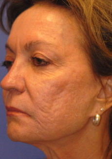Patient 3 before photo of Acne Scars patient at Sensational Skin Scottsdale