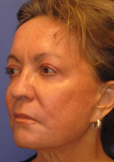 Patient 3 after photo of Acne Scars patient at Sensational Skin Scottsdale