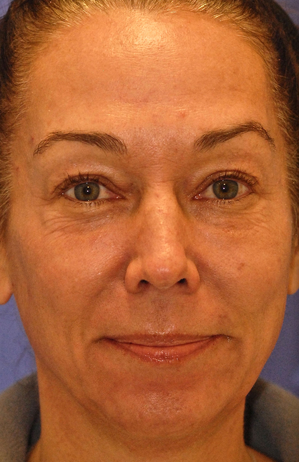 Patient 3 before photo of PDO Threadlift patient at Sensational Skin Scottsdale