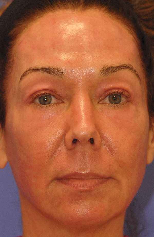 Patient 3 after photo of PDO Threadlift patient at Sensational Skin Scottsdale