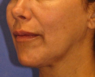 Patient 4 before photo of PDO Threadlift patient at Sensational Skin Scottsdale