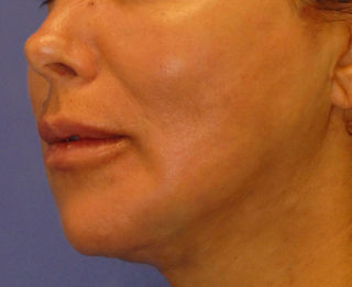 Patient 4 after photo of PDO Threadlift patient at Sensational Skin Scottsdale