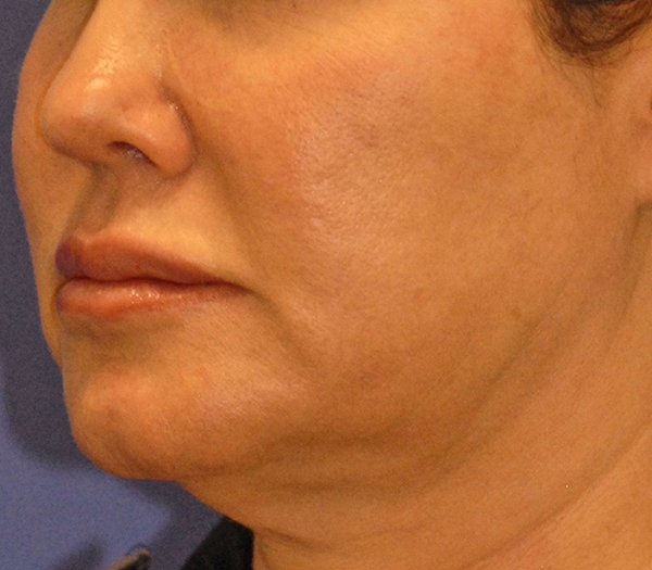 Patient 2 before photo of PDO Threadlift patient at Sensational Skin Scottsdale