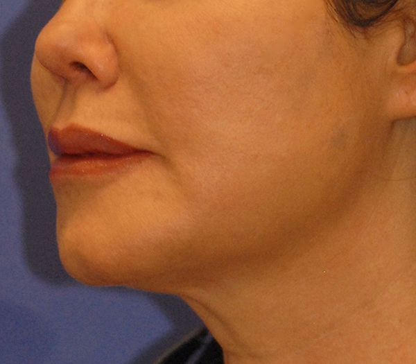 Patient 2 after photo of PDO Threadlift patient at Sensational Skin Scottsdale
