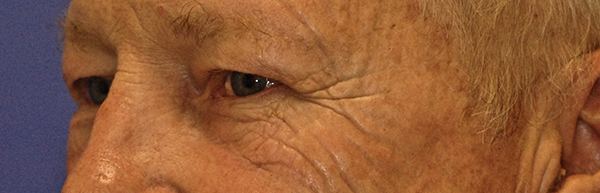 Patient 1 before photo of Laser EyeLid Lift patient at Sensational Skin Scottsdale