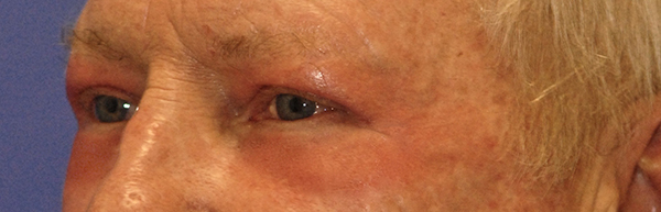 Patient 1 after photo of Laser EyeLid Lift patient at Sensational Skin Scottsdale