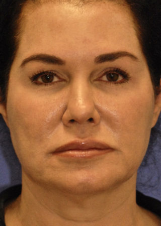 Patient 6 before photo of PDO Threadlift patient at Sensational Skin Scottsdale