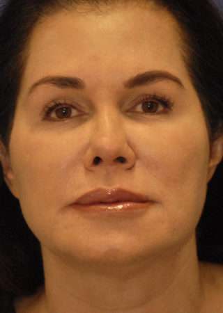Patient 6 after photo of PDO Threadlift patient at Sensational Skin Scottsdale