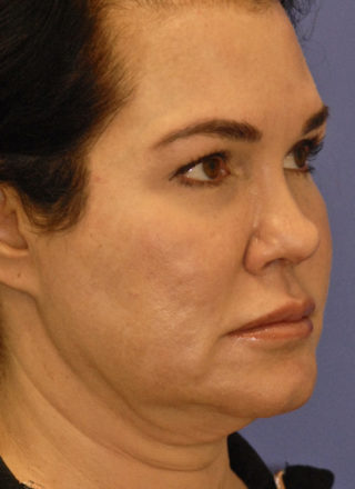 Patient 6 before photo of PDO Threadlift patient at Sensational Skin Scottsdale