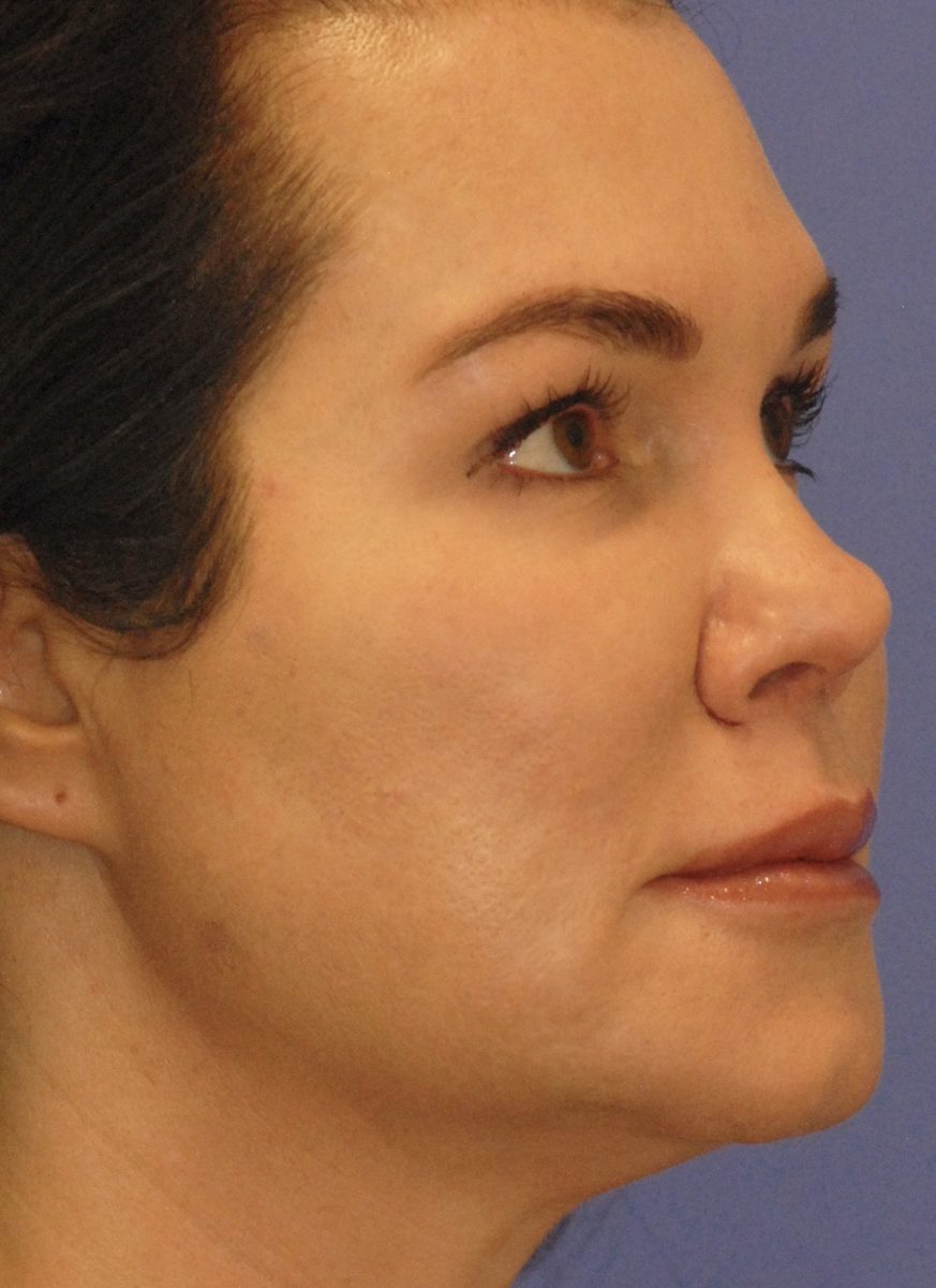 Patient 6 after photo of PDO Threadlift patient at Sensational Skin Scottsdale