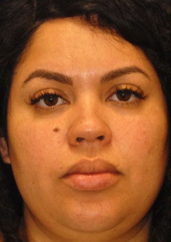 Patient 2 before photo of Juvederm patient at Sensational Skin Scottsdale