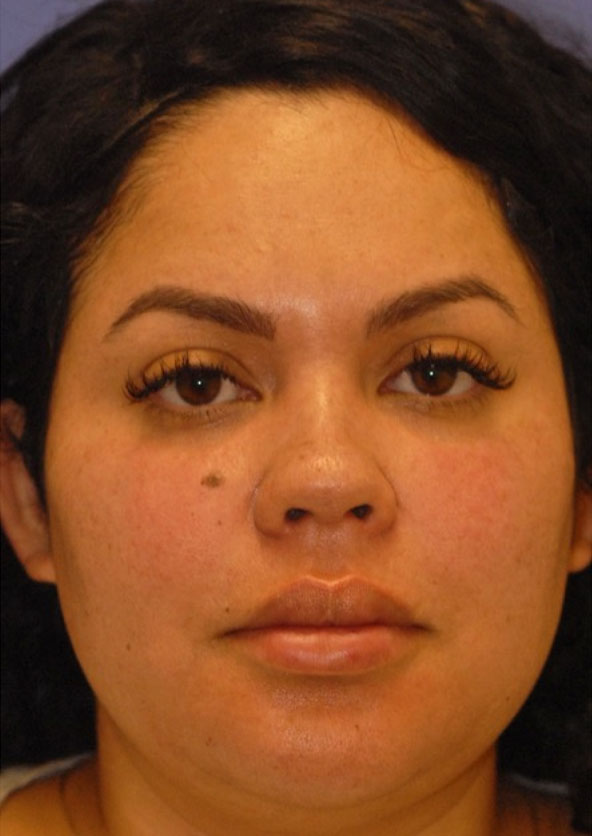 Patient 2 after photo of Juvederm patient at Sensational Skin Scottsdale